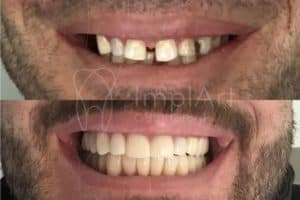 como é feito um implante dentário 44