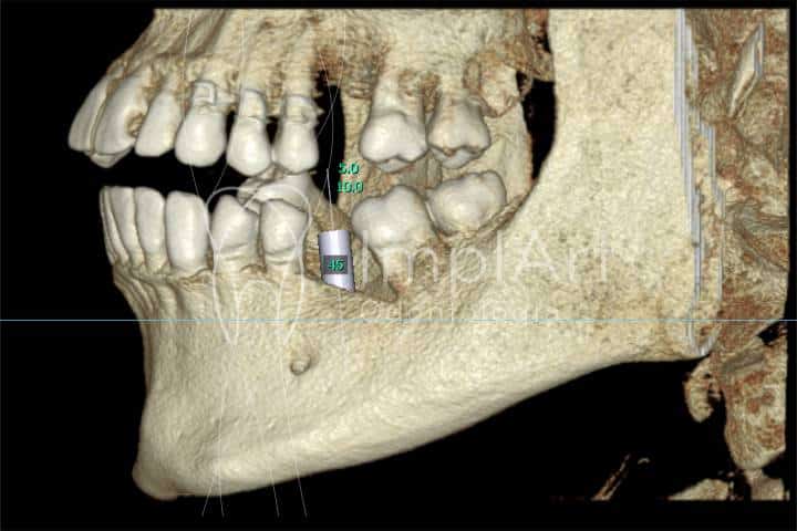 tomografia para planejamento de implantes dentários
