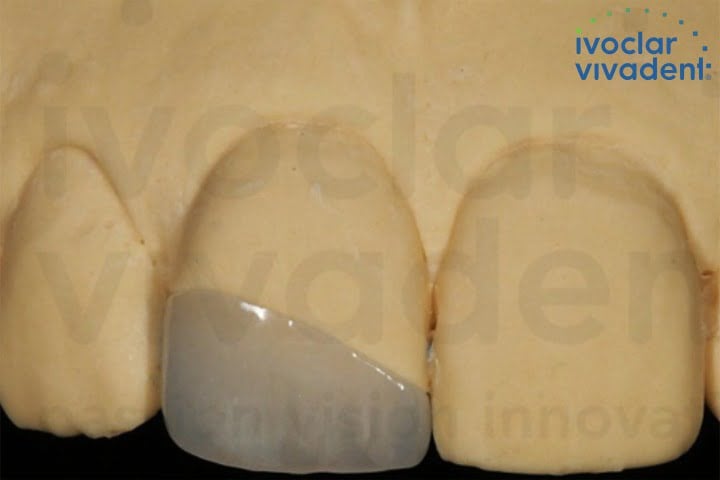 fragmento ceramico lente dental 50kb