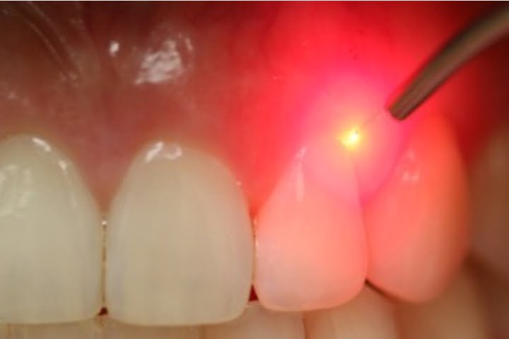 laserterapia odontológica