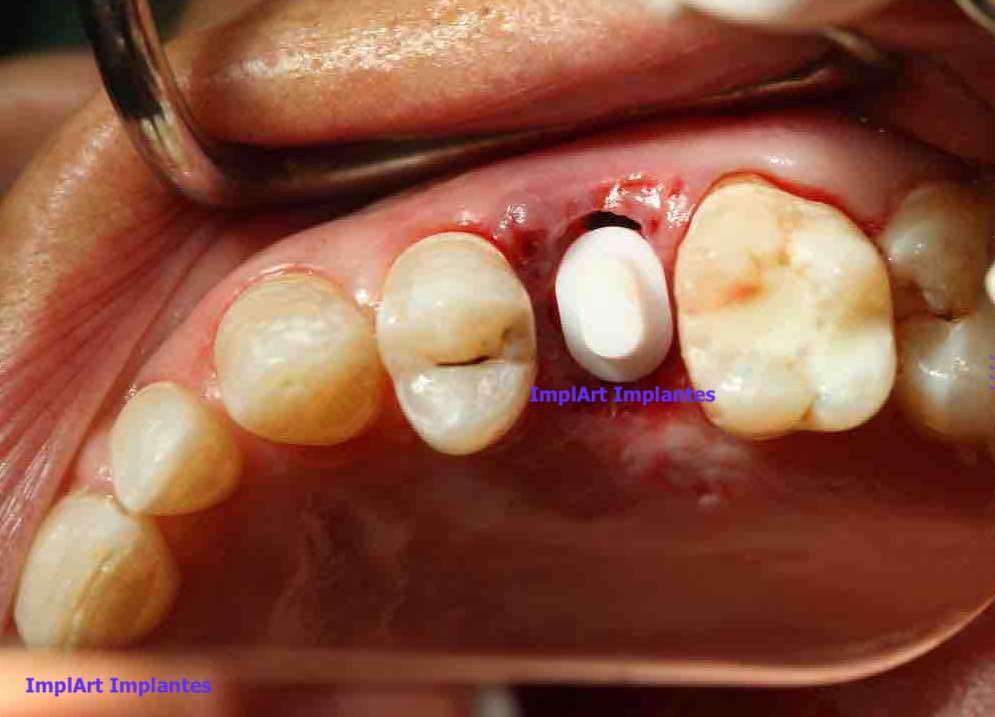 implante de zircônia instalado