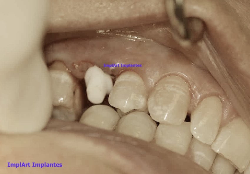implante de zircônia odontologia biológica