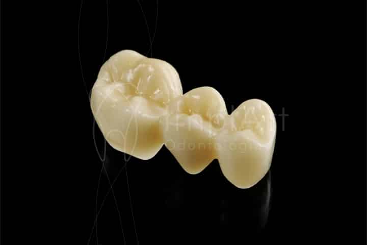 ponte dentaria zirconia 50kb