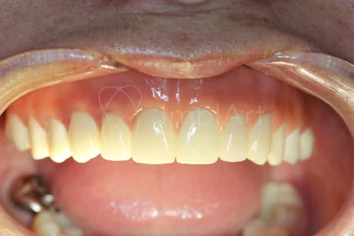 protese total em zirconia para implantes estetica