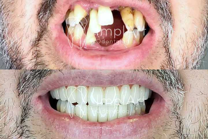 reabilitação oral total com implantes dentário