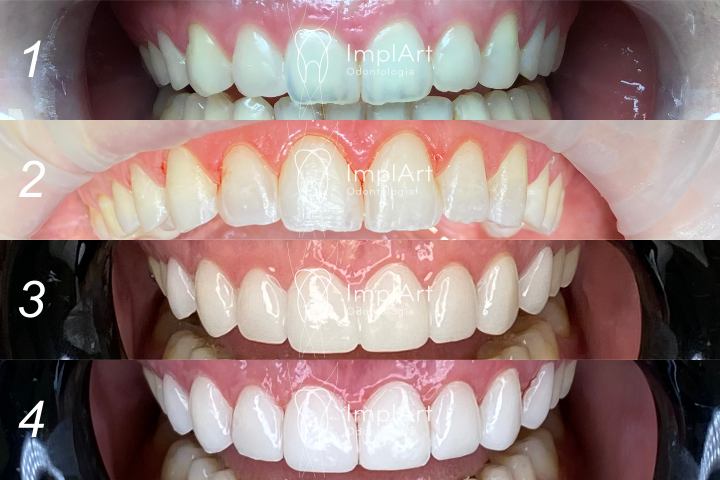 lente contato dentao e gengivectomia antes e depois 50kb