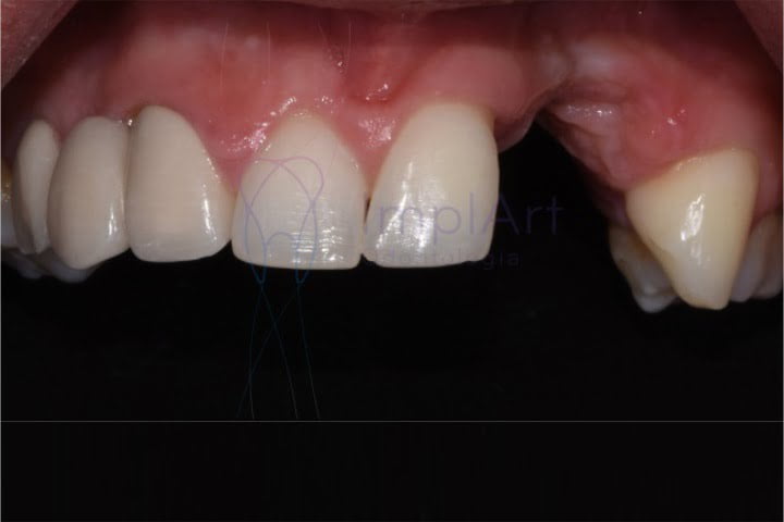 perda dos dentes leva a perda óssea e defeito gengival