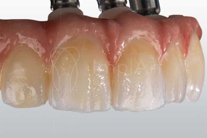 coroas de zirconia translucida para implante