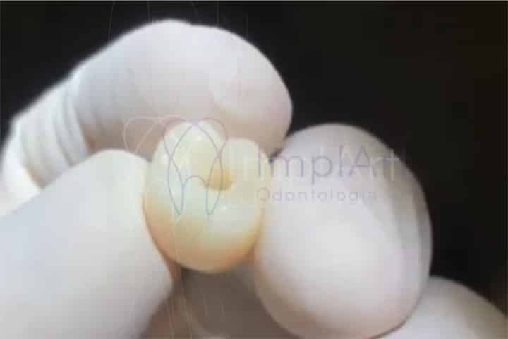 coroa dentaria de zirconia translucida