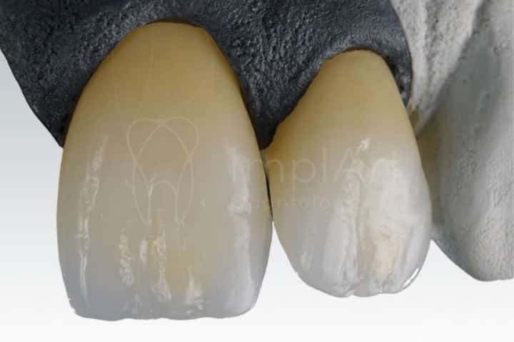 zirconia translucida para coroas sobre implantes