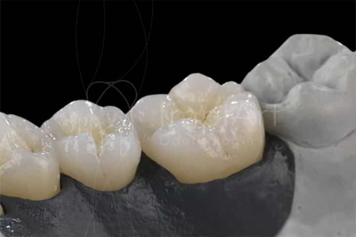 coroas de zirconia para implantes