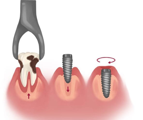 Extrair dente e colocar implante dentário no mesmo dia
