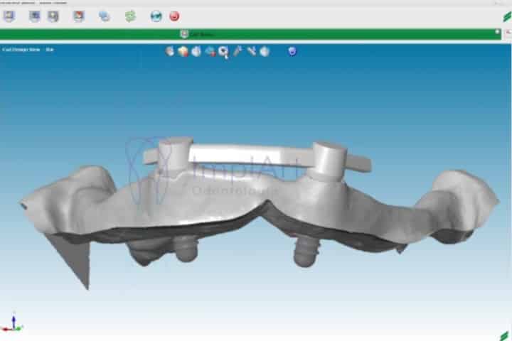 A prótese dental protocolo dentário com barra em titânio é mais leve ? 2 protocolo branemark barra titanio 48kb