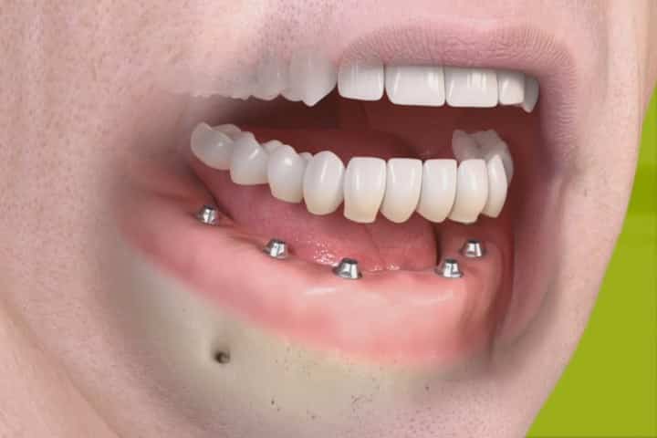 implante de todos os dentes de arcada inferior