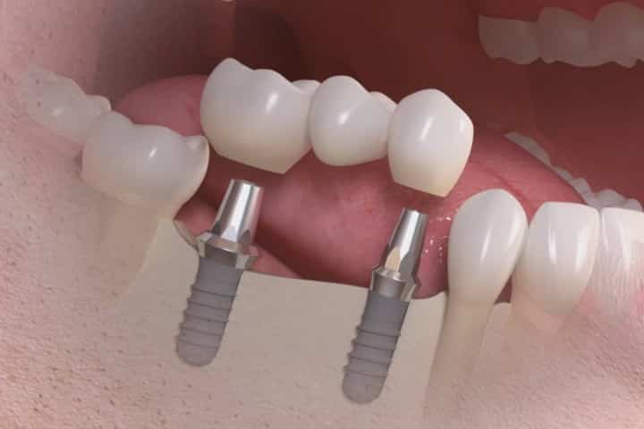 implante parcial ponte dentaria fixa