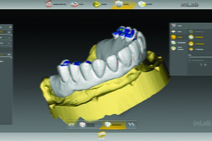 projeto computadorizado de protese dentaria