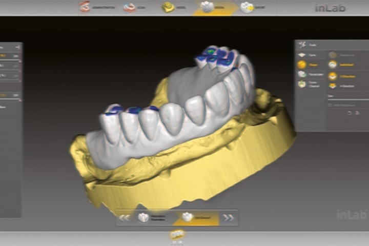 projeto computadorizado de protese dentaria para materiais modernos