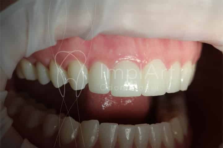 Lente contato dental 50