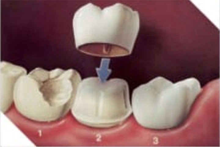 coroa dental instalada sobre nucleo 50kb