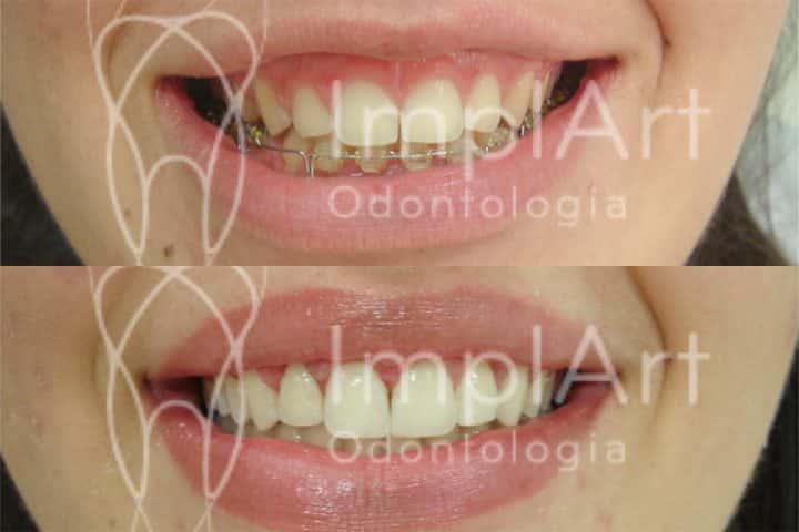 gengivectomia e recontorno dental