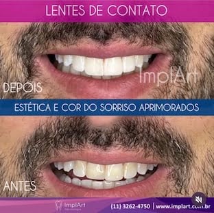 lente de contato dental antes e depois