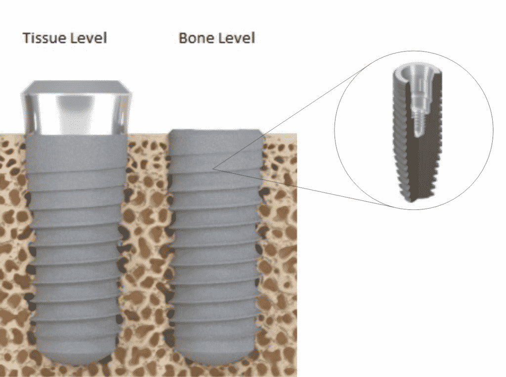 bone_level_x_tissue_level2 - ImplArt