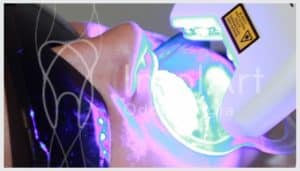 clareamento dental