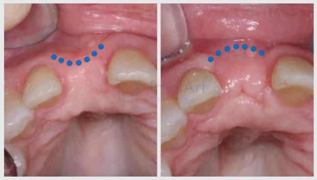 enxerto osseo antes e depois 41kb 2