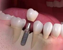 riscos do implante dentário
