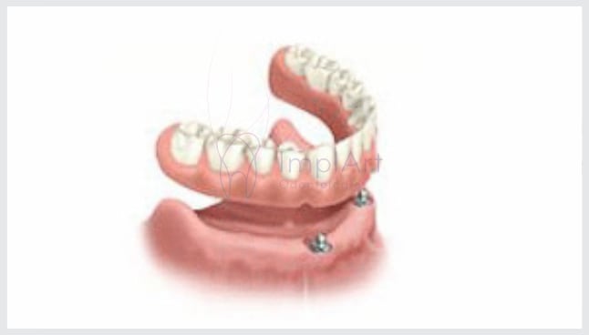 overdenture 14kb 1