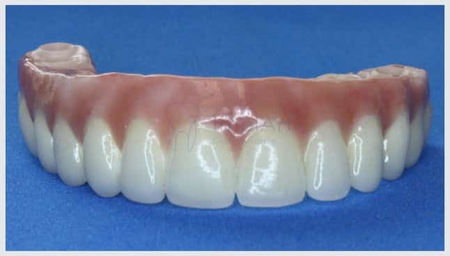 Implante de vários dentes protese total