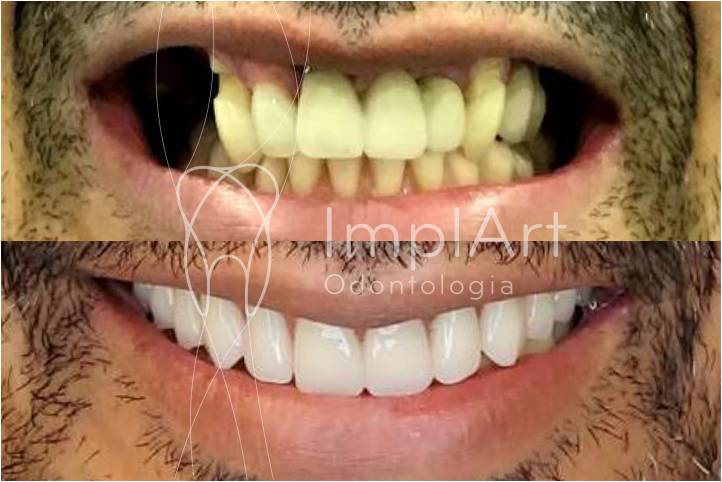 protese total resina dentes nacionais antes e depois 49k