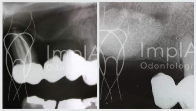 radiografia enxerto osseo antes depois 42kb 1