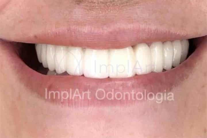 Protese de zirconia dental sem gengiva.