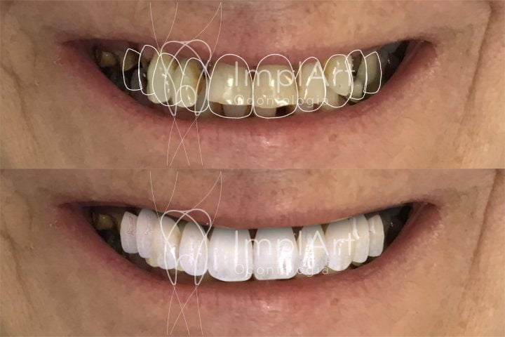 Protese dentaria zirconia projeto computador sobreposicao 50kb