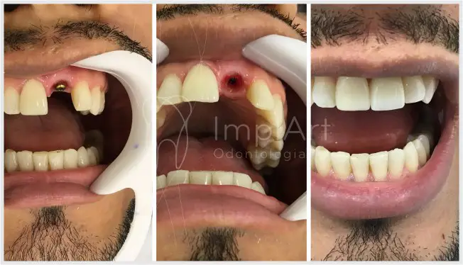implante de um dente coroa de porcelana dente de porcelana