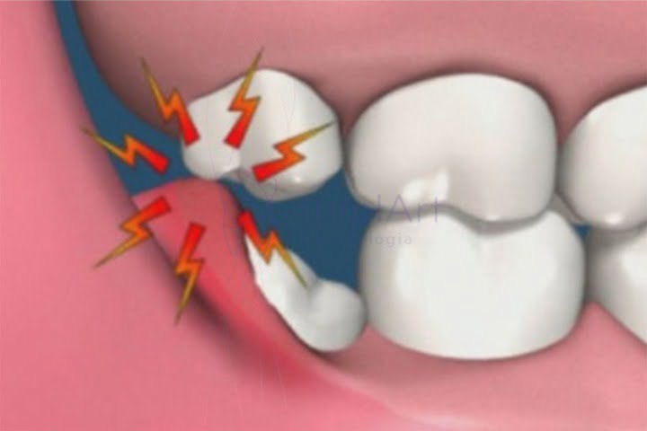 pericoronarite dente siso machucando 50kb