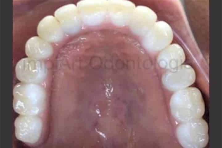 protese protocolo zirconia translucida branca sem metal 50kb