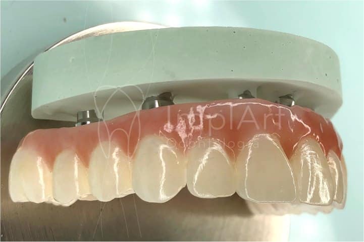 prótese protocolo com implantes material em zirconia translucida