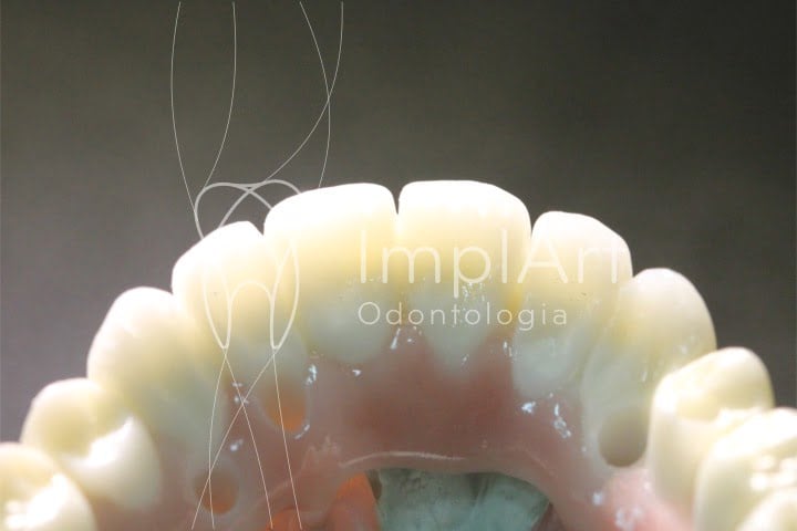 protese de zirconia e translucidez