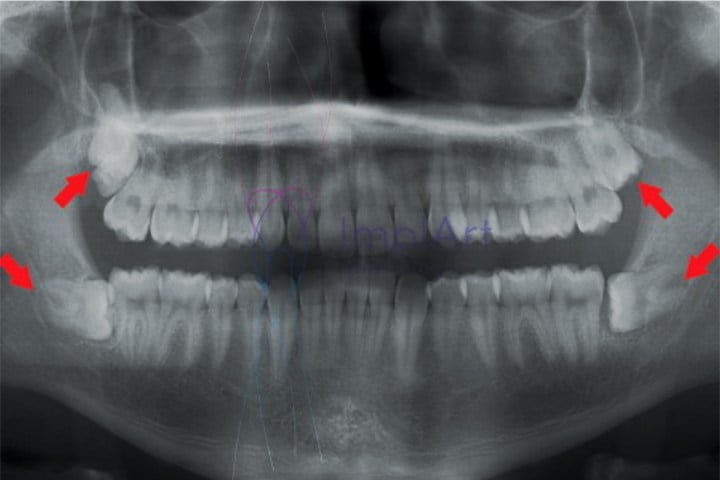 extrair dentes do siso