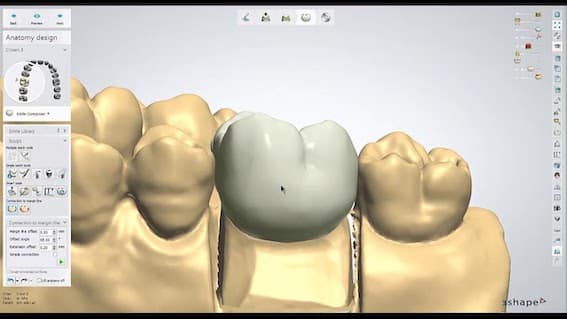 coroa dentaria em um dia