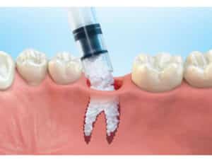 enxerto_osseo_dentario