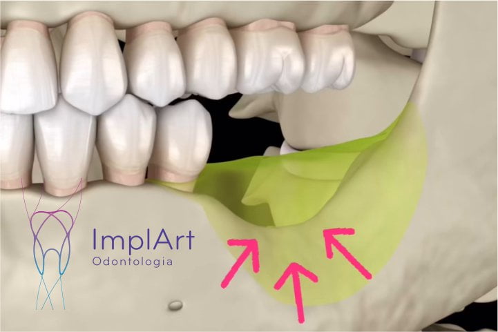 Implante dentario de um dente evita PERDA ÓSSEA DENTARIA