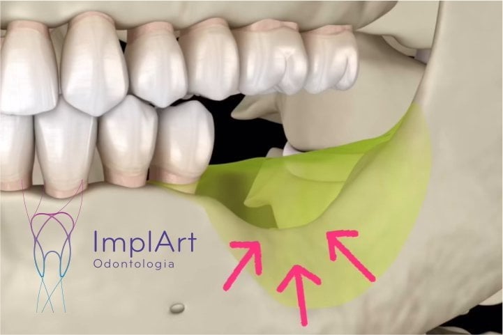 Implante dentario de um dente evita PERDA ÓSSEA DENTARIA