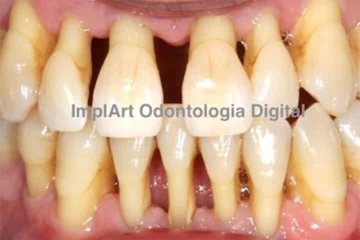 perda ossea retracao gengival 50kb