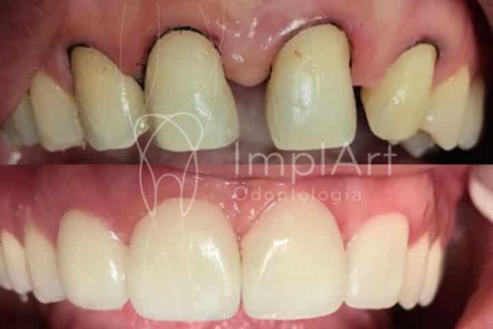 lente contato dental diastema antes e depois 50kb