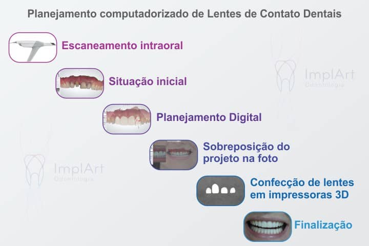 lentes de contato para os dentes