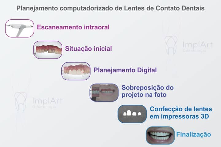 planejamento computadorizado lentes dentais 50kb