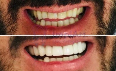antes e depois de colocar lentes de contato dental
